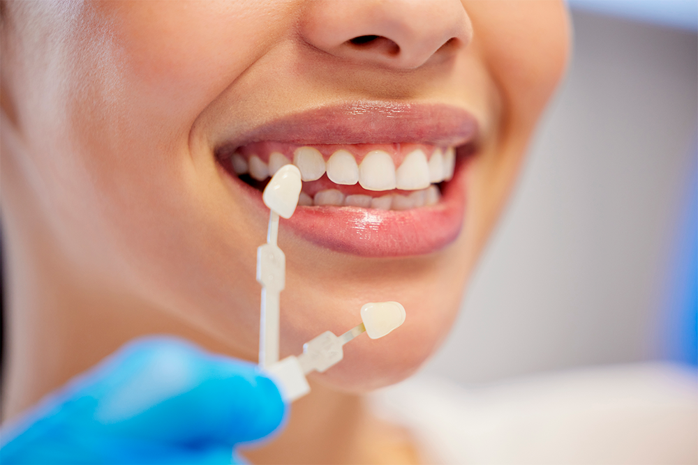 Blanqueamiento en casa