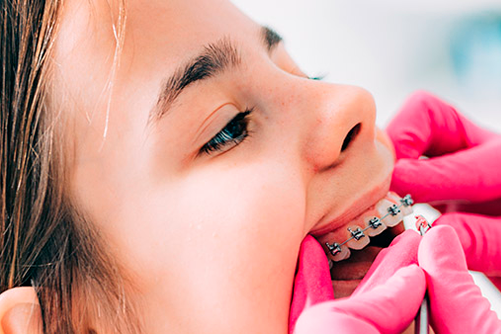Brackets de baja fricción