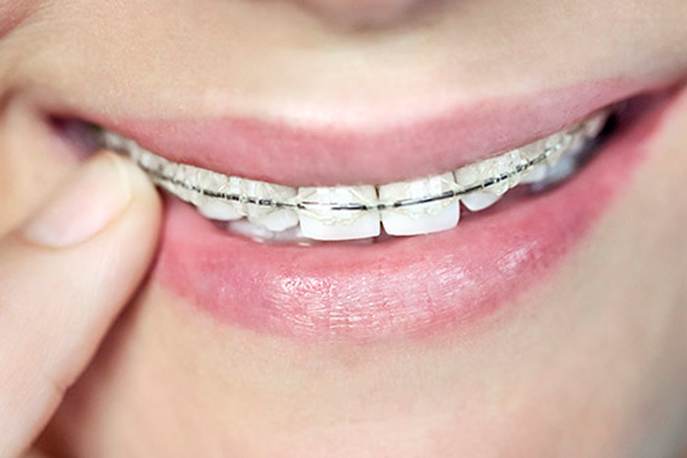 Brackets estéticos