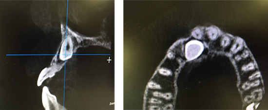 cirugia caninos incluidos