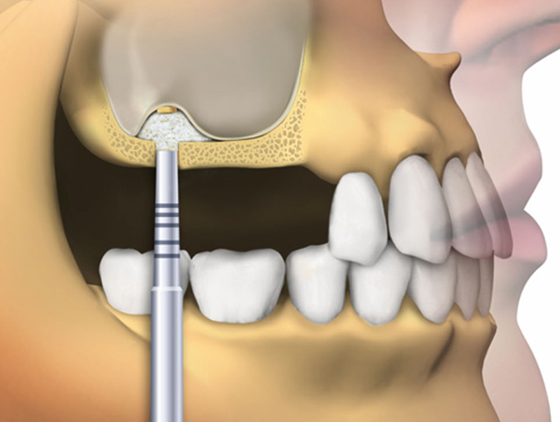 injertos cirugia oral alcala de henares